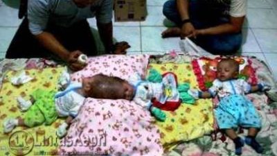 Bayi Kembar Siam, Nadhira Alifa Putri dan Nadhiba Aisyah Putri (dalam keadaan dempet) dan Nadhiva Alinka Putri (bayi yang lahir terpisah). foto: Aji Anugraha