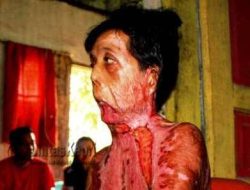 Besok Penderita Luka Bakar Serius Dibawa Ke Rumah Sakit