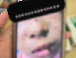 Beredar Kabar Seorang Anak di Bintan Terpapar Virus MPOX