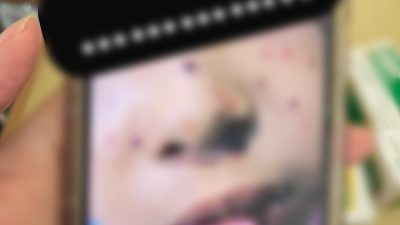 Beredar Kabar Seorang Anak di Bintan Terpapar Virus MPOX